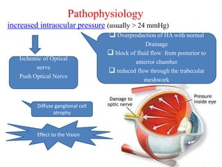 Pathophysiology
increased intraocular pressure (usually > 24 mmHg)
 Overproduction of HA with normal
Drainage
 block of fluid flow from posterior to
anterior chamber
 reduced flow through the trabecular
meshwork
Ischemic of Optical
nerve
Push Optical Nerve
Diffuse ganglional cell
atrophy
Effect to the Vision
 