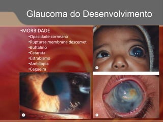 •MORBIDADE
•Opacidade corneana
•Rupturas membrana descemet
•Buftalmo
•Catarata
•Estrabismo
•Ambliopia
•Cegueira
Glaucoma do Desenvolvimento
 