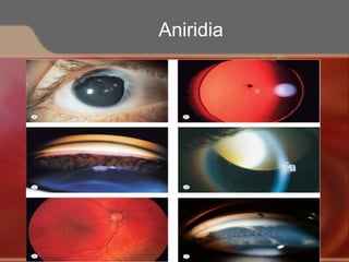 Aniridia
 