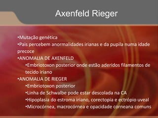 •Mutação genética
•Pais percebem anormalidades irianas e da pupila numa idade
precoce
•ANOMALIA DE AXENFELD
•Embriotoxon posterior onde estão aderidos filamentos de
tecido iriano
•ANOMALIA DE RIEGER
•Embriotoxon posterior
•Linha de Schwalbe pode estar descolada na CA
•Hipoplasia do estroma iriano, corectopia e ectrópio uveal
•Microcórnea, macrocórnea e opacidade corneana comuns
Axenfeld Rieger
 