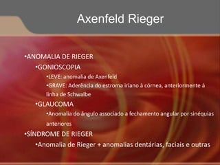 •ANOMALIA DE RIEGER
•GONIOSCOPIA
•LEVE: anomalia de Axenfeld
•GRAVE: Aderência do estroma iriano à córnea, anteriormente à
linha de Schwalbe
•GLAUCOMA
•Anomalia do ângulo associado a fechamento angular por sinéquias
anteriores
•SÍNDROME DE RIEGER
•Anomalia de Rieger + anomalias dentárias, faciais e outras
Axenfeld Rieger
 
