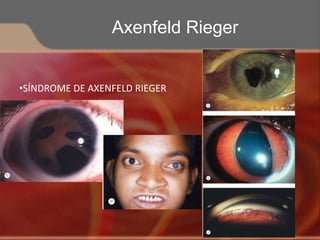 •SÍNDROME DE AXENFELD RIEGER
Axenfeld Rieger
 