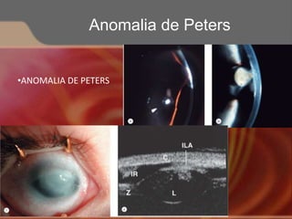 •ANOMALIA DE PETERS
Anomalia de Peters
 