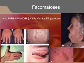•NEUROFIBROMATOSE (dça de Von Recklinghausen)
Facomatoses
 