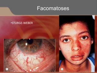 •STURGE-WEBER
Facomatoses
 