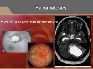 •VON HIPPEL-LINDAU (angiomatose retiniana)
Facomatoses
 