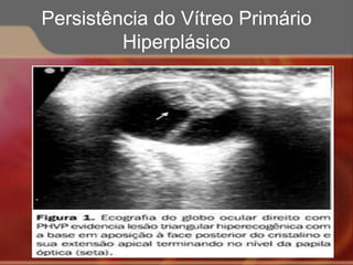 Persistência do Vítreo Primário
Hiperplásico
 