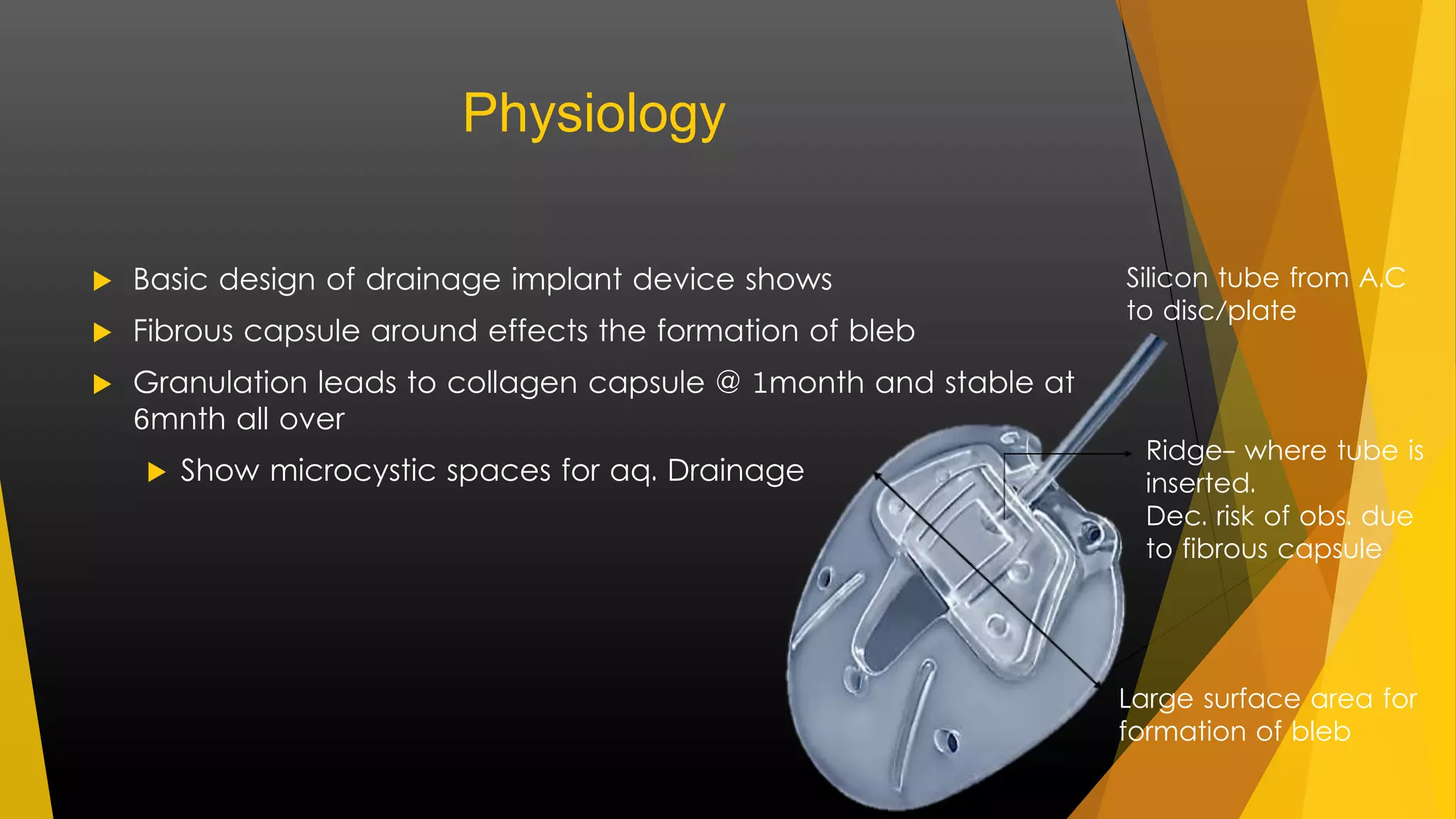 Physiology 
 Basic design of drainage implant device shows 
 Fibrous capsule around effects the formation of bleb 
 Granulation leads to collagen capsule @ 1month and stable at 
6mnth all over 
 Show microcystic spaces for aq. Drainage 
Silicon tube from A.C 
to disc/plate 
Ridge- where tube is 
inserted. 
Dec. risk of obs. due 
to fibrous capsule 
Large surface area for 
formation of bleb 
 