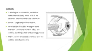 Schocket:
 A 360 degree silicone band, as used in
detachment surgery, which acts as the
reservoir into which the tube is inserted.
 Needs a large conjunctival incision.
 Modifications include a 90 degree band
between 2 recti and insertion into a pre-
existing band implanted for buckling purposes
 Didn’t provide any added advantage over the
existing open tube models.
 