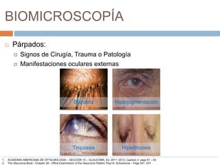 BIOMICROSCOPÍA
 Párpados:
 Signos de Cirugía, Trauma o Patología
 Manifestaciones oculares externas
Blefaritis Hiperpigmentación
Triquiasis Hipertricosis
1. ACADEMIA AMERICANA DE OFTALMOLOGÍA – SECCIÓN 10 – GLAUCOMA, Ed. 2011 -2012, Capitulo 3, pags 81 – 83
2. The Glaucoma Book - Chapter 28 - Office Examination of the Glaucoma Patient, Paul N. Schacknow – Pags 301 -337
 