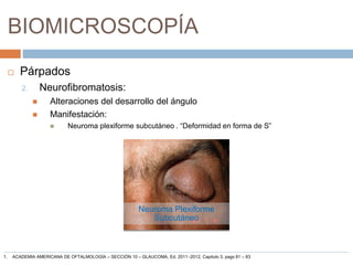 BIOMICROSCOPÍA
 Párpados
2. Neurofibromatosis:
 Alteraciones del desarrollo del ángulo
 Manifestación:
 Neuroma plexiforme subcutáneo . “Deformidad en forma de S”
Neuroma Plexiforme
Subcutáneo
1. ACADEMIA AMERICANA DE OFTALMOLOGÍA – SECCIÓN 10 – GLAUCOMA, Ed. 2011 -2012, Capitulo 3, pags 81 – 83
 