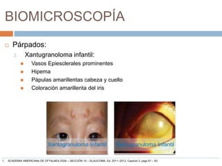 BIOMICROSCOPÍA
 Párpados:
3. Xantugranoloma infantil:
 Vasos Epiesclerales prominentes
 Hipema
 Pápulas amarillentas cabeza y cuello
 Coloración amarillenta del iris
Xantogranuloma Infantil Xantugranuloma Infantil
1. ACADEMIA AMERICANA DE OFTALMOLOGÍA – SECCIÓN 10 – GLAUCOMA, Ed. 2011 -2012, Capitulo 3, pags 81 – 83
 