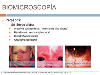 BIOMICROSCOPÍA
 Párpados:
4. Sd. Sturge Weber
 Angioma cutáneo facial “Mancha de vino oporto”
 Hipertensión venosa epiescleral
 Hipertrofia hemifacial
 Glaucoma ipsilateral
“Mancha de vino oporto” Buftalmo Hemangioma epiescleral
1. ACADEMIA AMERICANA DE OFTALMOLOGÍA – SECCIÓN 10 – GLAUCOMA, Ed. 2011 -2012, Capitulo 3, pags 81 – 83
 