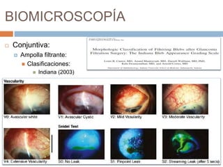 BIOMICROSCOPÍA
 Conjuntiva:
 Ampolla filtrante:
 Clasificaciones:
 Indiana (2003)
 