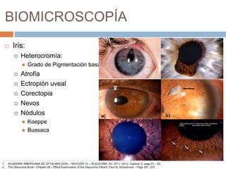BIOMICROSCOPÍA
 Iris:
 Heterocromía:
 Grado de Pigmentación basal
 Atrofia
 Ectropión uveal
 Corectopia
 Nevos
 Nódulos
 Koeppe
 Bussaca
1. ACADEMIA AMERICANA DE OFTALMOLOGÍA – SECCIÓN 10 – GLAUCOMA, Ed. 2011 -2012, Capitulo 3, pags 81 – 83
2. The Glaucoma Book - Chapter 28 - Office Examination of the Glaucoma Patient, Paul N. Schacknow – Pags 301 -337
 
