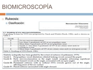 BIOMICROSCOPÍA
 Rubeosis:
 Clasificación:
 