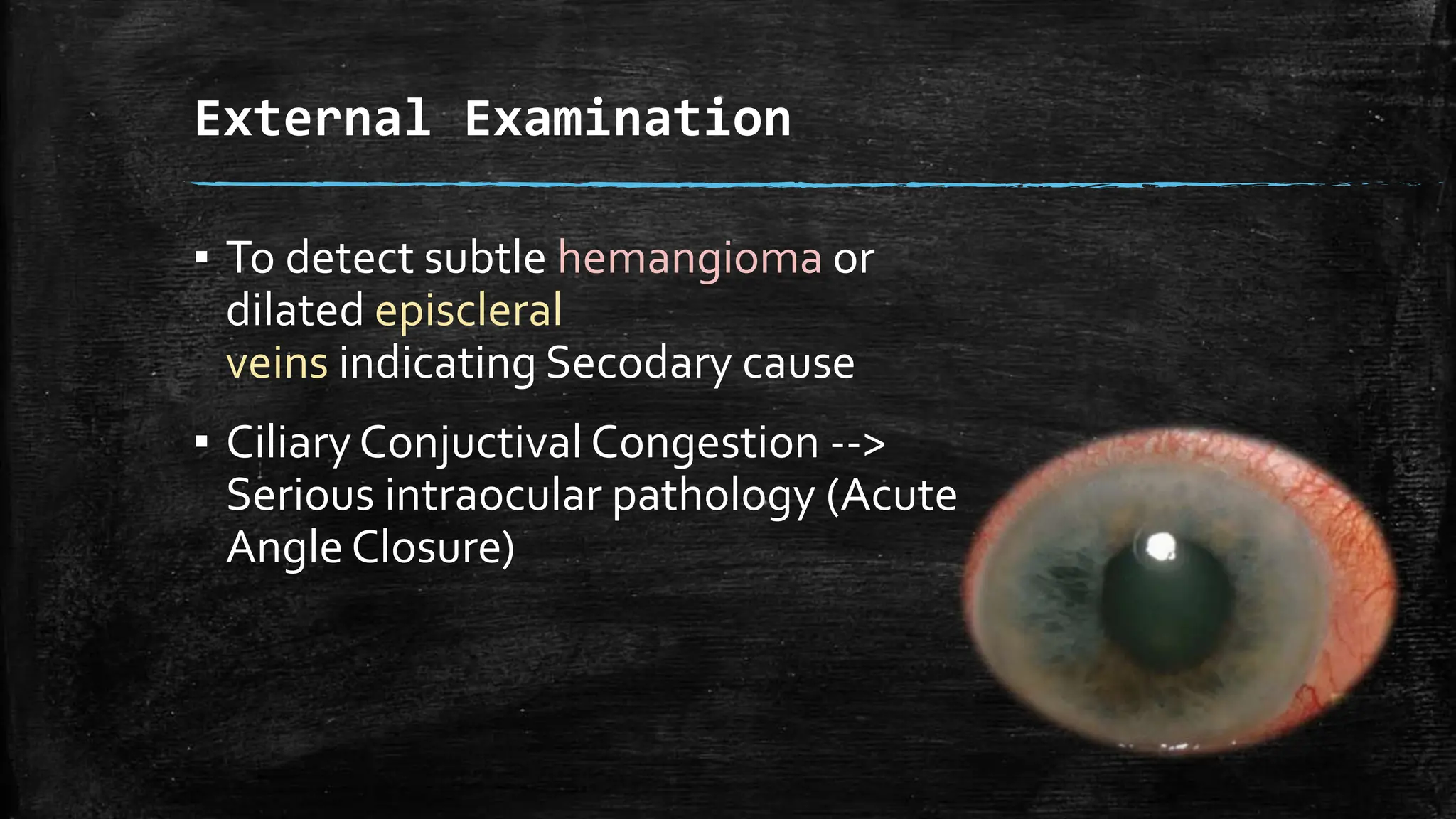 External Examination
▪ To detect subtle hemangioma or
dilated episcleral
veins indicating Secodary cause
▪ CiliaryConjuctival Congestion -->
Serious intraocular pathology (Acute
Angle Closure)
 
