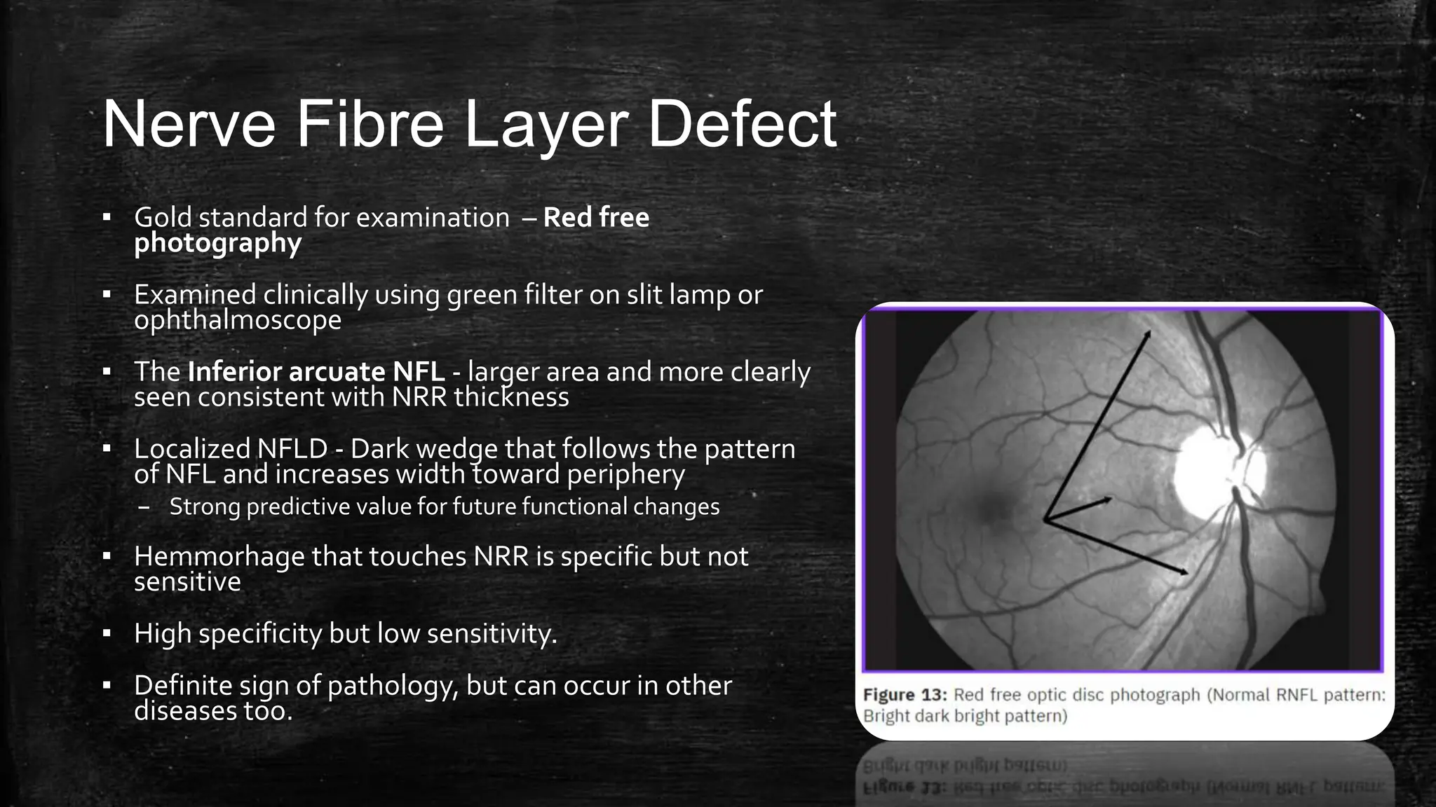 Nerve Fibre Layer Defect
▪ Gold standard for examination – Red free
photography
▪ Examined clinically using green filter on slit lamp or
ophthalmoscope
▪ The Inferior arcuate NFL - larger area and more clearly
seen consistent with NRR thickness
▪ Localized NFLD - Dark wedge that follows the pattern
of NFL and increases width toward periphery
– Strong predictive value for future functional changes
▪ Hemmorhage that touches NRR is specific but not
sensitive
▪ High specificity but low sensitivity.
▪ Definite sign of pathology, but can occur in other
diseases too.
 
