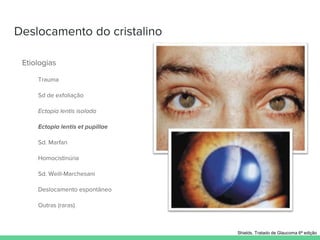 Deslocamento do cristalino
Etiologias
Trauma
Sd de exfoliação
Ectopia lentis isolada
Ectopia lentis et pupillae
Sd. Marfan
Homocistinúria
Sd. Weill-Marchesani
Deslocamento espontâneo
Outras (raras)
Shields. Tratado de Glaucoma 6ª edição
 
