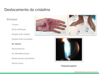 Deslocamento do cristalino
Etiologias
Trauma
Sd de exfoliação
Ectopia lentis isolada
Ectopia lentis et pupillae
Sd. Marfan
Homocistinúria
Sd. Weill-Marchesani
Deslocamento espontâneo
Outras (raras)
Int Med Case Rep J. 2016; 9: 149–153.
Temporal superior
 