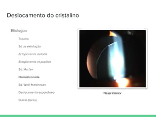 Deslocamento do cristalino
Etiologias
Trauma
Sd de exfoliação
Ectopia lentis isolada
Ectopia lentis et pupillae
Sd. Marfan
Homocistinúria
Sd. Weill-Marchesani
Deslocamento espontâneo
Outras (raras)
Nasal inferior
 