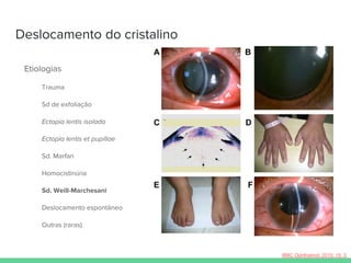 Deslocamento do cristalino
Etiologias
Trauma
Sd de exfoliação
Ectopia lentis isolada
Ectopia lentis et pupillae
Sd. Marfan
Homocistinúria
Sd. Weill-Marchesani
Deslocamento espontâneo
Outras (raras)
BMC Ophthalmol. 2015; 15: 3.
 