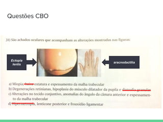 Questões CBO
Ectopia
lentis
aracnodactilia
 