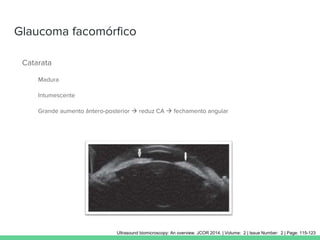 Glaucoma facomórfico
Catarata
Madura
Intumescente
Grande aumento ântero-posterior  reduz CA  fechamento angular
Ultrasound biomicroscopy: An overview. JCOR 2014. | Volume: 2 | Issue Number: 2 | Page: 115-123
 