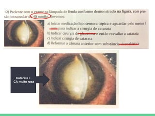Catarata +
CA muito rasa
 