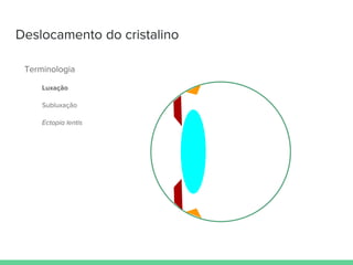 Deslocamento do cristalino
Terminologia
Luxação
Subluxação
Ectopia lentis
 