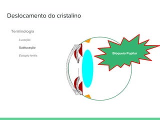 Deslocamento do cristalino
Terminologia
Luxação
Subluxação
Ectopia lentis
Bloqueio Pupilar
 