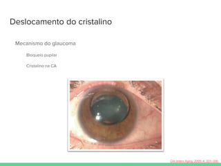 Deslocamento do cristalino
Mecanismo do glaucoma
Bloqueio pupilar
Cristalino na CA
Clin Interv Aging. 2009; 4: 331–336.
 