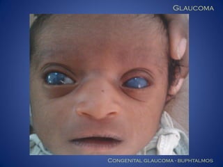 Glaucoma

Congenital glaucoma - buphtalmos

 
