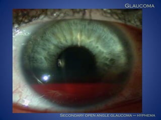 Glaucoma

Secondary open angle glaucoma – hyphema

 
