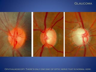 Glaucoma

Ophthalmoscopy. There’s only one disc of optic nerve that is normal here.

 