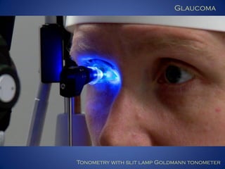 Glaucoma

Tonometry with slit lamp Goldmann tonometer

 