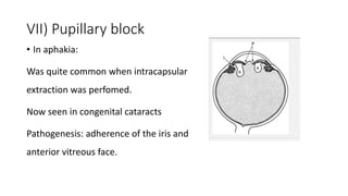 VII) Pupillary block
• In aphakia:
Was quite common when intracapsular
extraction was perfomed.
Now seen in congenital cataracts
Pathogenesis: adherence of the iris and
anterior vitreous face.
 