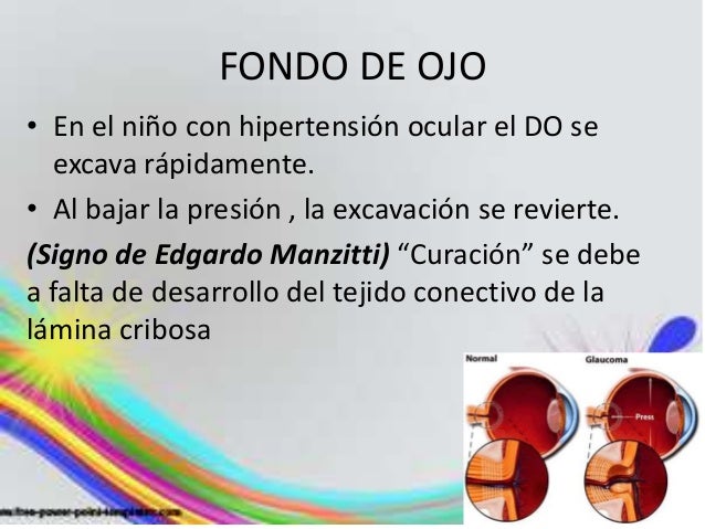 El Ibuprofeno Sube La Tension Ocular