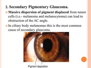 2. Secondary Pigmentary Glaucoma.
 Massive dispersion of pigment displaced from tumor
cells (i.e.- melanoma and melanocytoma) can lead to
obstruction of the AC angle.
 In ciliary body melanomas this is the most common
cause of secondary glaucoma.
 