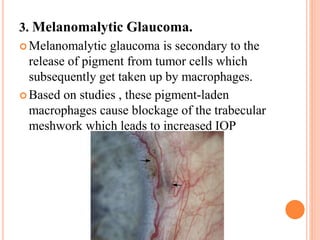 3. Melanomalytic Glaucoma.
 Melanomalytic glaucoma is secondary to the
release of pigment from tumor cells which
subsequently get taken up by macrophages.
 Based on studies , these pigment-laden
macrophages cause blockage of the trabecular
meshwork which leads to increased IOP
 