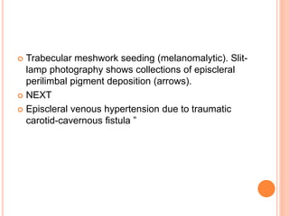  Trabecular meshwork seeding (melanomalytic). Slit-
lamp photography shows collections of episcleral
perilimbal pigment deposition (arrows).
 NEXT
 Episcleral venous hypertension due to traumatic
carotid-cavernous fistula ”
 
