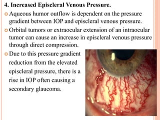 4. Increased Episcleral Venous Pressure.
 Aqueous humor outflow is dependent on the pressure
gradient between IOP and episcleral venous pressure.
 Orbital tumors or extraocular extension of an intraocular
tumor can cause an increase in episcleral venous pressure
through direct compression.
 Due to this pressure gradient
reduction from the elevated
episcleral pressure, there is a
rise in IOP often causing a
secondary glaucoma.
 