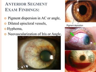 ANTERIOR SEGMENT
EXAM FINDINGS:
 Pigment dispersion in AC or angle,
 Dilated episcleral vessels,
 Hyphema,
 Neovascularization of Iris or Angle,
 