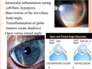 o Intraocular inflammation noting
cell/flare, hypopyon,
o Mass lesions of the iris/ciliary
body/angle,
o Transillumination of globe
(tumors create shadows)
o Open versus closed angle
 