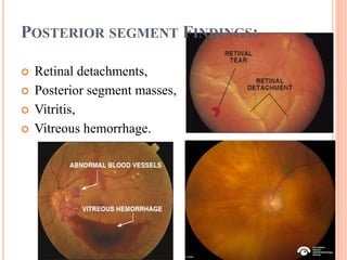 POSTERIOR SEGMENT FINDINGS:
 Retinal detachments,
 Posterior segment masses,
 Vitritis,
 Vitreous hemorrhage.
 