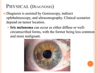 PHYSICAL (DIAGNOSIS)
 Diagnosis is assisted by Gonioscopy, indirect
ophthalmoscopy, and ultrasonography. Clinical scenarios
depend on tumor location.
 Iris melanoma can occur as either diffuse or well-
circumscribed forms, with the former being less common
and more malignant.
 