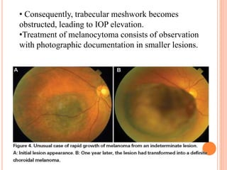 • Consequently, trabecular meshwork becomes
obstructed, leading to IOP elevation.
•Treatment of melanocytoma consists of observation
with photographic documentation in smaller lesions.
 