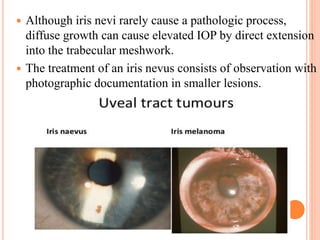 Although iris nevi rarely cause a pathologic process,
diffuse growth can cause elevated IOP by direct extension
into the trabecular meshwork.
 The treatment of an iris nevus consists of observation with
photographic documentation in smaller lesions.
 
