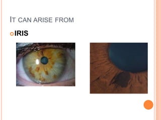IT CAN ARISE FROM
IRIS
 