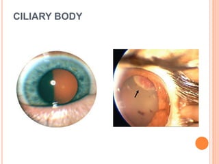 CILIARY BODY
 